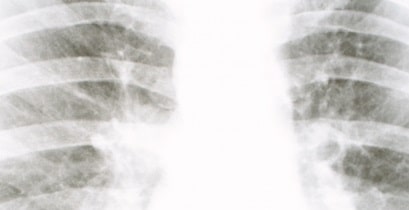 肺がん末期の症状