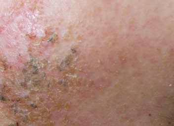アトピー性皮膚炎の疫学