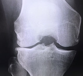 膝の痛みの画像検査でわかる病気