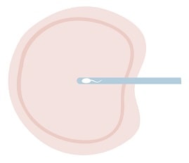 体外受精と顕微鏡受精を選択するケース