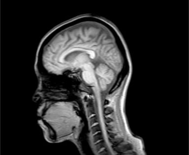 パニック障害と脳神経の仮説