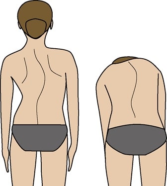 脊柱側弯症（せきちゅうそくわんしょう）