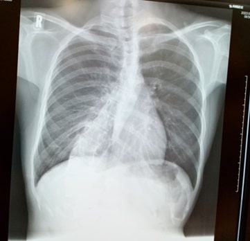 脊柱側弯症（せきちゅうそくわんしょう）1